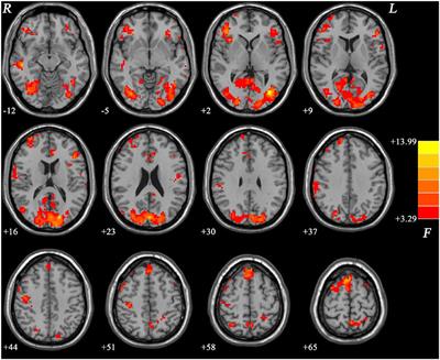 Differentiating Melancholic and Non-melancholic Major Depressive Disorder Using Fractional Amplitude of Low-Frequency Fluctuations